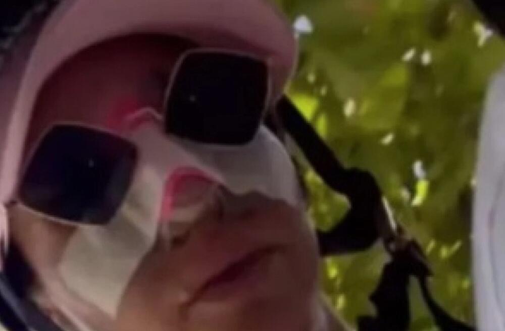 DELE SE SABLASNE SLIKE RIJALITI UČESNICE SA PINKA! Cela glava joj u podlivima, prizor za nevericu