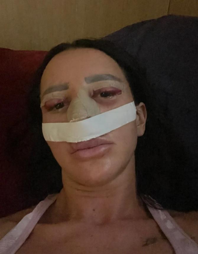 RIJALITI UČESNICA POSLE NIZA OPERACIJA U LOŠEM STANJU: "Ne mogu da govorim, cela sam otečena"