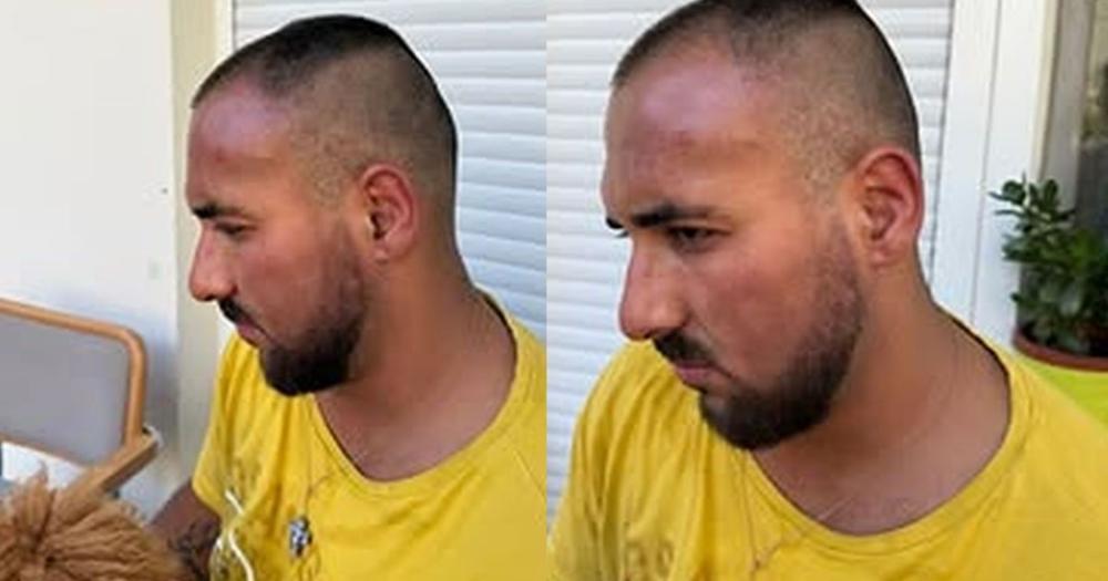 Prve slike brutalno pretučenog zadrugara: Jezive povrede po glavi, pomodreo skroz