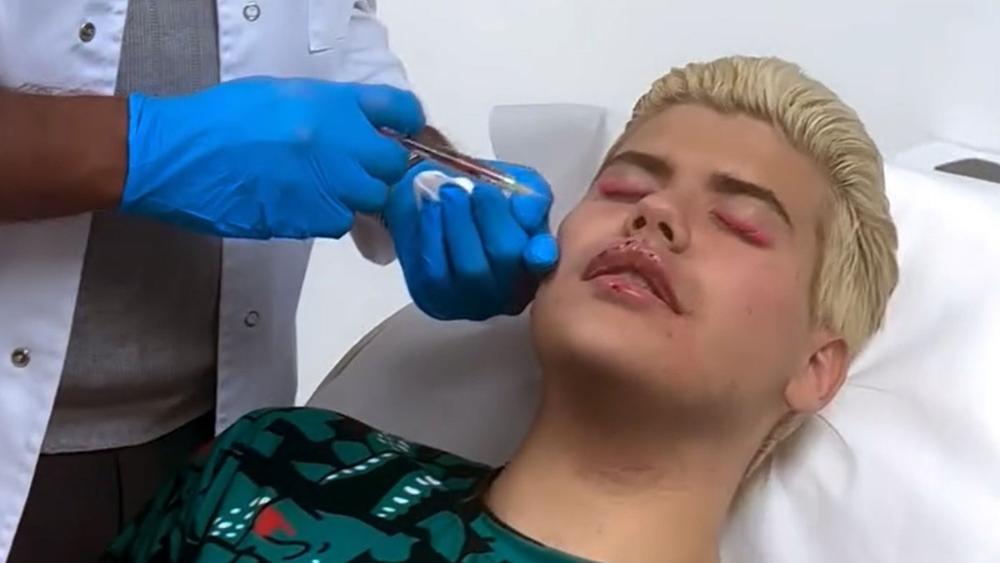 Uroš Stanić povećao usne i jagodice pred početak Elite 10