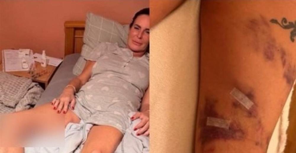Uznemirujući prizor! Kačavenda cela u modricama i podlivima - Evo koga krivi za tumor