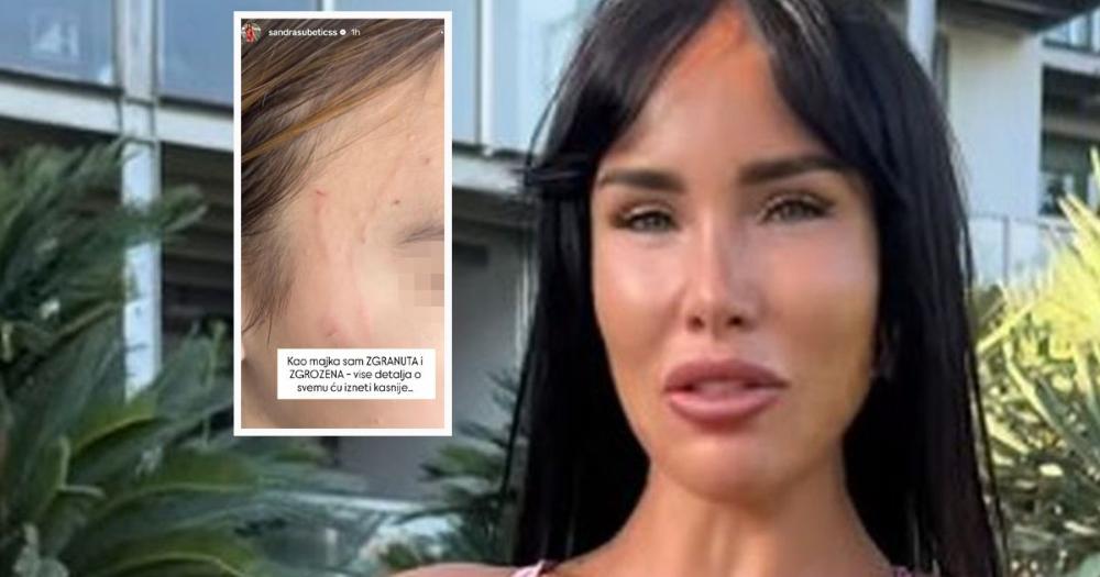 "MOJE DETE JE PRETUČENO" Aleksandra Subotić objavila potresne slike ćerke, na licu i vratu ogrebotine