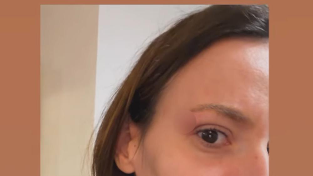 Kristina Spalević se oglasila i pokazala modricu: "Razvalio mi je arkadu"