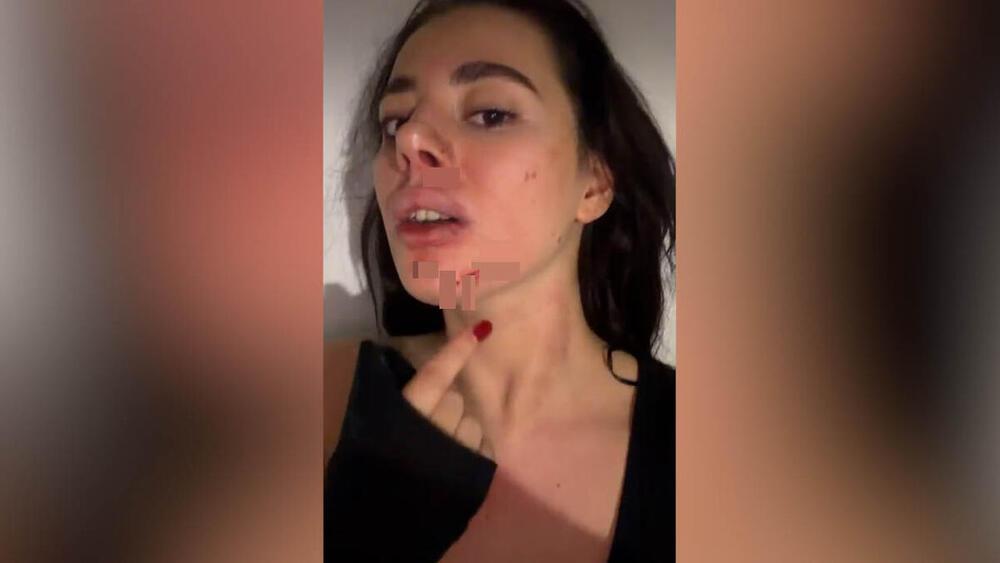 (UZNEMIRUJUĆE SLIKE) PRETUČENA BIVŠA RIJALITI UČESNICA! Naneo joj ozbiljne POVREDE po telu, a evo šta je POVOD