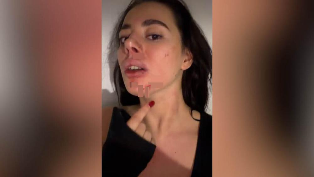 BIVŠA RIJALITI UČESNICA BRUTALNO PRETUČENA! Pronašla poruke u partnerovom telefonu, pa usledio haos: I dalje strahujem za svoju bezbednost... (VIDEO)