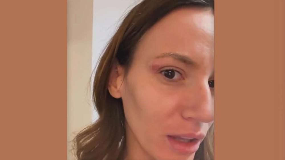 "PRE TRI SEKUNDE ME JE UDARIO, POMODRELO JE I OTEKLO!" Kristina Spalević snimljena sa modricom na licu