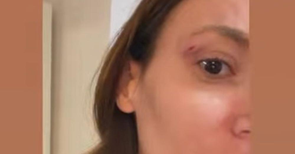 "Udario me, isekao": Kristini Spalević pukla arkada, hitno se oglasila i pokazala modricu!