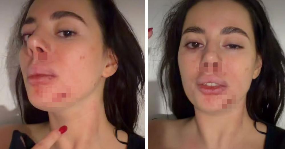 Jezive fotografije pretučene zadrugarke - lice u podlivima, oko poluzatvoreno: Oglasila se usred noći